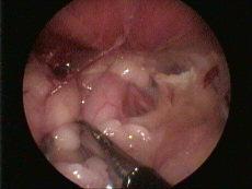 re ro omia pr -p bica videoa i ida em um elino com e eno e ure ral encaminhado para urestrostomia laparoscópica híbrida pré-púbica.