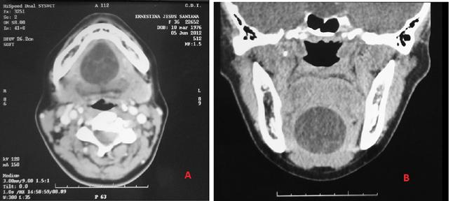 Figura 02- A - TC de face (janela para tecidos moles): A - Corte axial: imagem hipodensa, bem delimitada, localizada em região lingual da mandíbula.