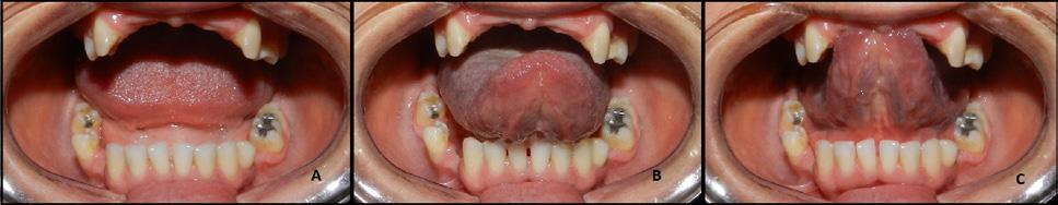 NERI et al. 28 atipias, assim como hipergranulose, havendo também aglomerado de glândulas sebáceas bem diferenciadas na parede fibrosa.