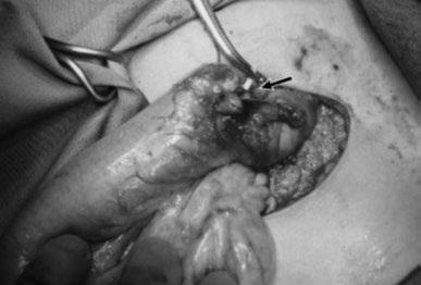 Apesar da perfuração e dos riscos de infecção, a maioria dos casos evolui bem e sem a necessidade de uma cirurgia abdominal maior. Figure 1.