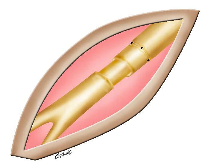 27 FIGURA 5 Esquema ilustrando o deslizamento do epineuro em direção ao coto proximal, no qual a sutura foi realizada 3.1.