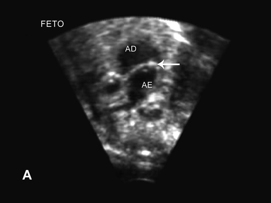 Fig. 1 - Atriosseptostomia com balão monitorada pela ecocardiografia em síndrome de hipoplasia de coração esquerdo com forame oval severamente restritivo.