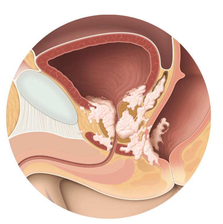 Colo vesical Reto Tumor Esfíncter urinário Opções de tratamento 2017 patients.uroweb ALL RIGHTS RESERVED Fig. 2: Tumor T4 da próstata que se espalhou para o colo vesical, esfíncter urinário e reto.