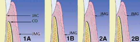 35 No tipo 1 há mucosa ceratinizada suficiente, sendo que a junção mucogengival encontra-se apicalmente à crista óssea, enquanto que no tipo 2 a faixa de mucosa ceratinizada é estreita, inferior a 4