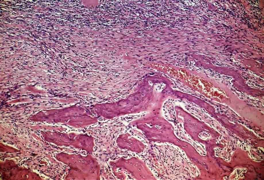 113 Resultado Grupo 4 (ViscoStat ) Junto ao terço cervical permanecem áreas de tecido conjuntivo com infiltrado inflamatório (Figura 51), e nele há predominância de linfócitos e macrófagos.