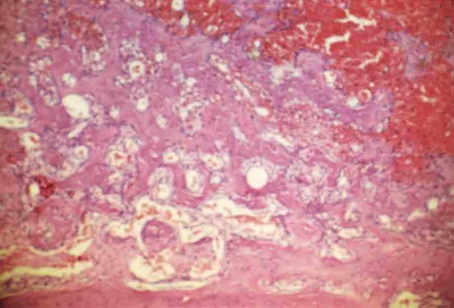 88 Resultado FIGURA 21 Grupo 1 (controle) 7 dias. Terço médio do alvéolo, junto da parede alveolar, com numerosas trabéculas ósseas. H.E., original 63X.
