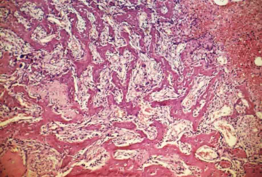 90 Resultado FIGURA 23 Grupo 2 (Hemostop ) 7 dias. Terço médio do alvéolo com trabéculas ósseas delgadas junto à parede óssea alveolar. H.E., original 63X.