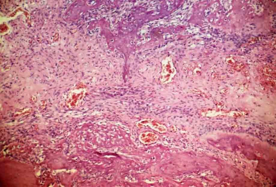 92 Resultado FIGURA 25 Grupo 3 (Pro-Tape ) 7 dias. Terço médio do alvéolo com tecido conjuntivo neoformado, e moderado número de fibroblastos e vasos sanguíneos. H.E., original 63X.