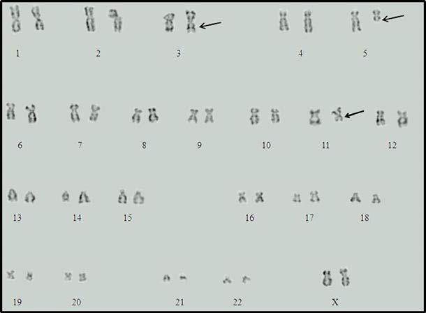 [46XX,inv(3)(q21q27),del(5)(q13),del(11)(q14)]. Figura 17.