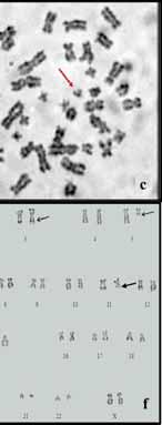 20q- observed in case 7; (e) complex karyotype of case 5 inv(3) (blue arrow), 5q- (green arrow) and 11q-