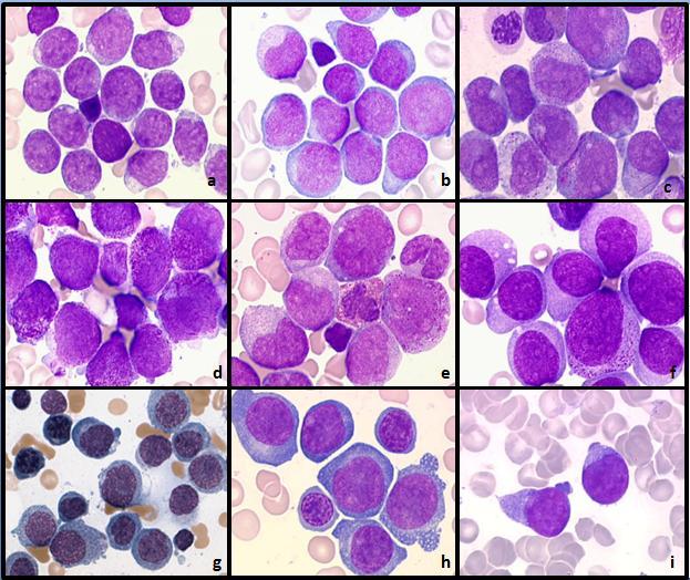 23 FIGURA 2: Morfologia celular da leucemia mielóide aguda de