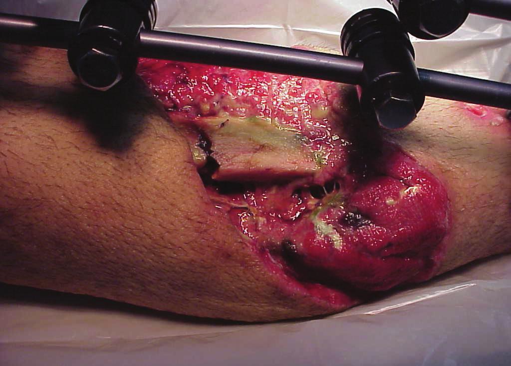 O período de seguimento variou de seis a 42 meses (figs. 1 a 6). As 580 C Fig. 2 Caso 7: A) Acidente automobilístico. Fratura dos ossos da perna.