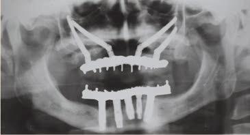 duplicação da prótese superior (Figura 7). Figura 6 - B - tele radiografia final.