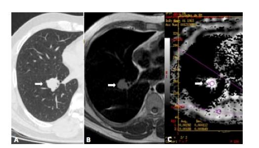 20 Figura 4 - Exame de TC e RM de paciente com adenocarcinoma de pulmão. Paciente do sexo masculino, 64 anos. O exame de radiografia de tórax demonstrou um nódulo no pulmão direito.