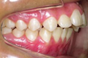Classe II ocorrem no plano sagital e, segundo Vargervik e Harvold 28, podem decorrer de: (1) deslocamento anterior da maxila ou do processo alveolar maxilar; (2) mandíbula pequena ou dentes