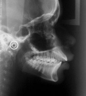 Quando o tratamento de uma Classe II completa sem apinhamento é realizado com extrações de dois pré-molares superiores, o segmento anterior do arco superior deverá ser distalizado o equivalente à