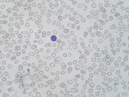 Microcitose e hipocromia Coloração: