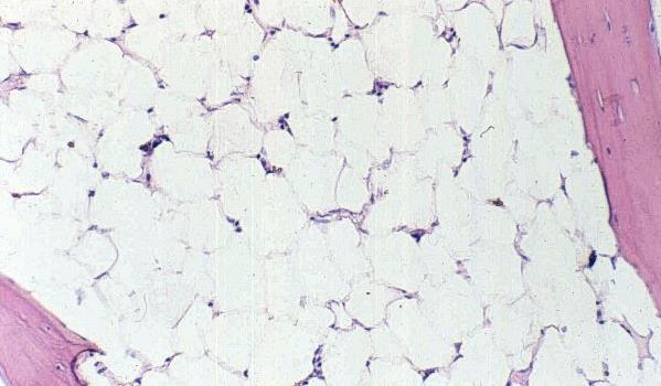 Anemia hipoplásica - Doença inflamatória - Insuficiência