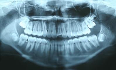 Apesar disto, o fragmento dentário somente foi acondicionado em soro fisiológico 30 dias depois do acidente, permanecendo por uma semana antes da cimentação.