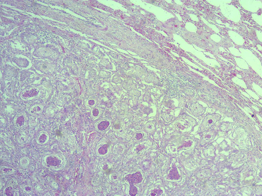 moderado pleomorfismo celular, raras figuras de mitose por campo de grande aumento (Figura 3). FIGURA 3. Equino, SRD, 20 anos. Fotomicrografia de metástase de carcinoma de células escamosas no pulmão.