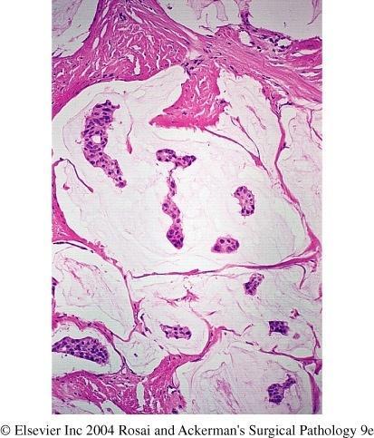 Carcinoma da Mama Outros Carcinomas Carcinoma lobular invasivo