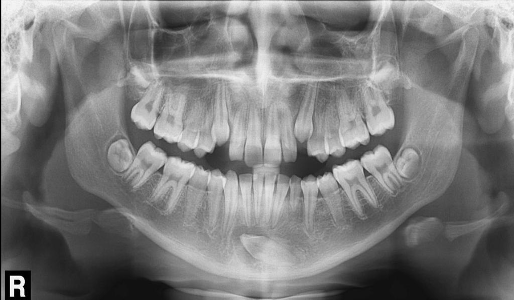 CISTO DENTÍGERO O cisto dentígero é aquele que envolve a coroa do elemento dental não/semi irrompido, expandindo seu capuz pericoronário.