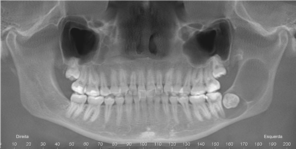 acometimento do terço posterior do corpo da mandíbula,  Diagnóstico