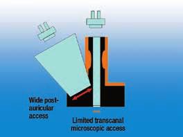O amplo ângulo de visão proporcionado pelo endoscópio permite um acesso minimamente invasivo à cavidade timpânica através do canal auditivo e uma visualização abrangente de estruturas-alvo da