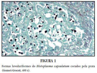 Histopatológico com presença de leveduras intracelulares