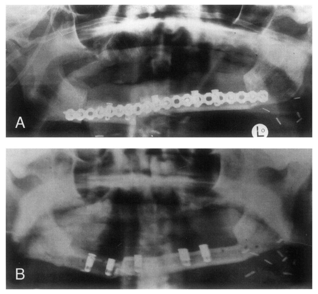 43 FIGURA 11 Radiografia panorâmica mostrando enxerto vascularizado imediato de fíbula, imobilizado com placa de reconstrução de 2.7 mm e colocação imediata de implantes (POGREL et al., 1997).