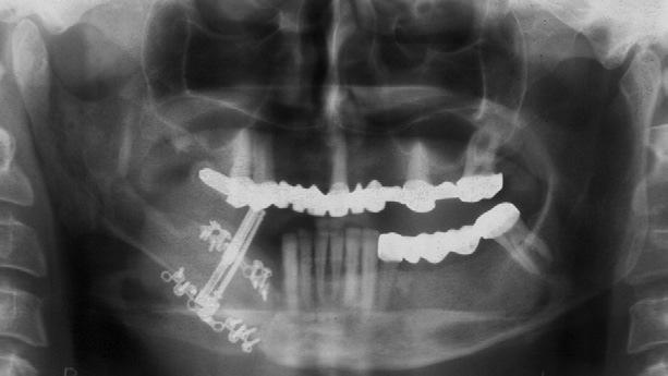 (KURKCU et al., 2008). Há diferentes métodos para aumentar a altura do enxerto de fíbula, como a técnica do duplo barril.