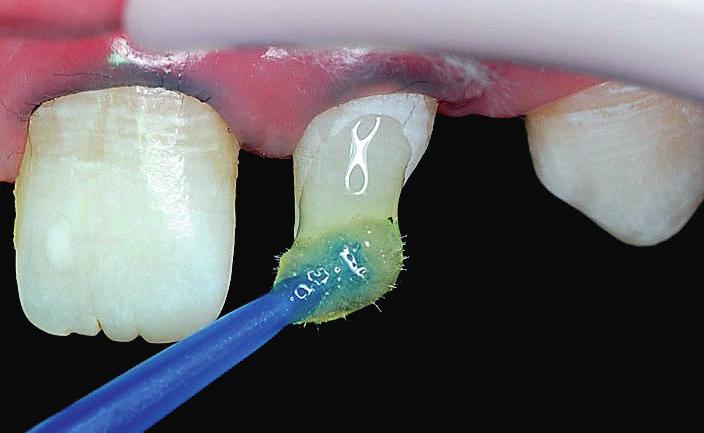 Após a prova da guia de silicone (Fig. 3), os dentes 12 e 22 foram condicionados com ácido fosfórico a 35% (Fig. 4) por 20s e, em seguida, lavados e secos com jato de ar.
