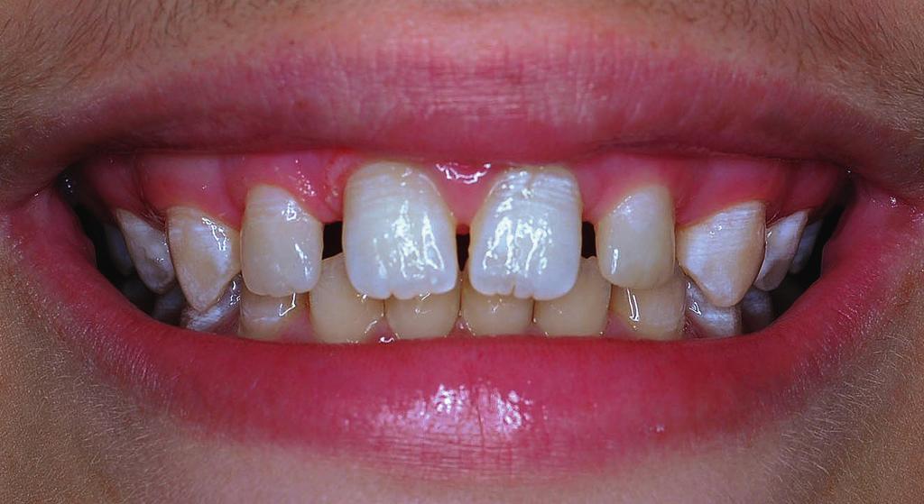 Para entre os dentes anterossuperiores. Dessa forma, será o acabamento e texturização, foram utilizadas pontas evitado um encurtamento da arcada superior, que diamantadas (Fig.