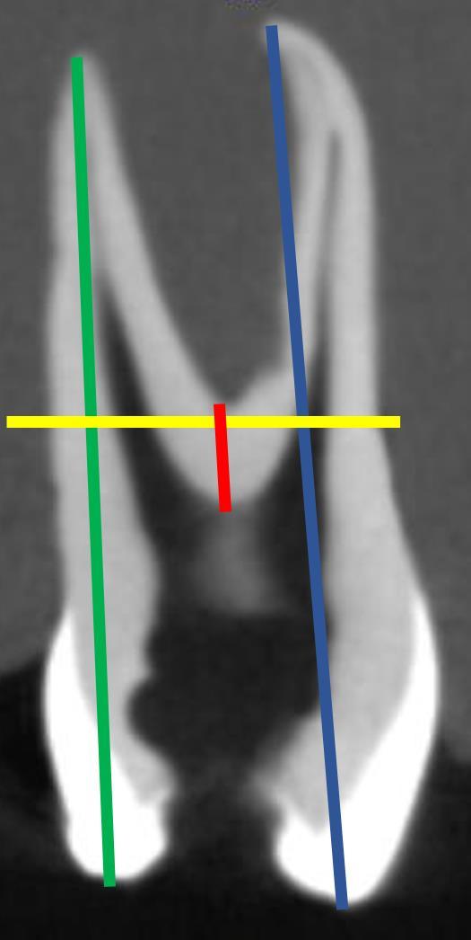 42 Figura 2 - Imagem de tomografia computadorizada de feixe cônico (plano sagital) mostrando o comprimento real do dente, (linha vertical azul raiz vestibular, linha vertical verde raiz palatina), a