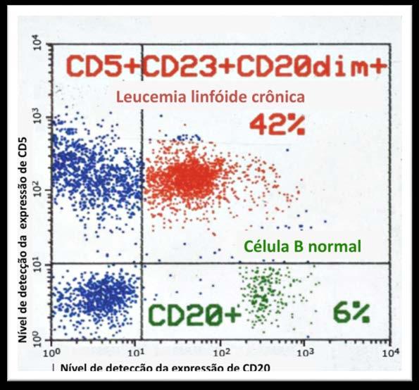 16 Figura 6 Análise imunofenotípica da LLC por citometria de fluxo.