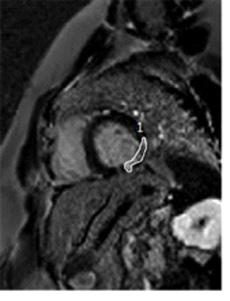 112 Int J Cardiovasc Sci. 2017;30(2):109-116 Figura 2 Medida da fibrose cardíaca pela técnica de realce tardio (1: área de fibrose).