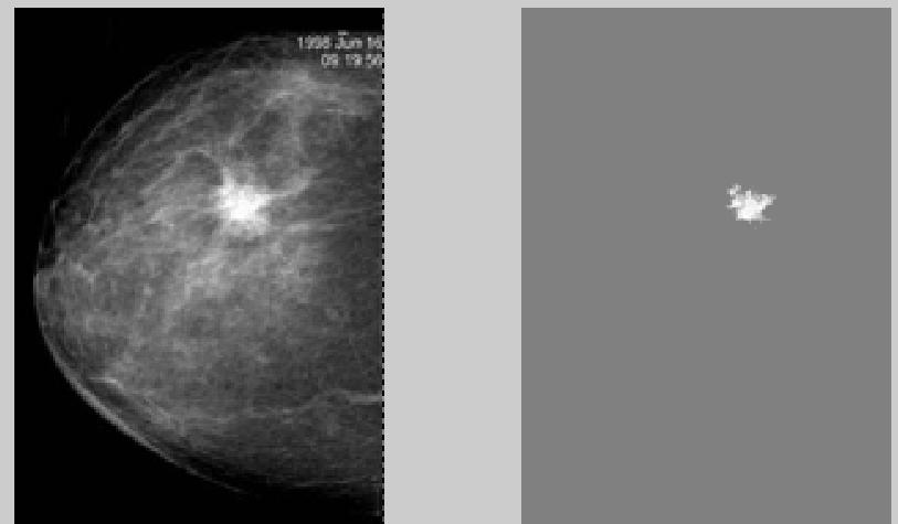 Segmentação Deteção de tumores na mama a partir de imagens de mamografia: transformada de Hough Imagem original Após