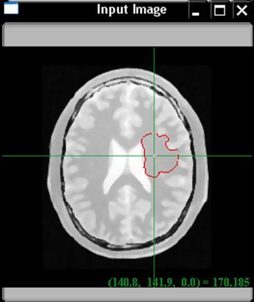 Segmentação Segmentação de objetos em imagens médicas: método de level set Imagem original Segmentação inicial Segmentação