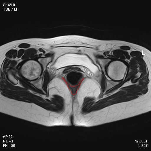 Segmentação Segmentação do pavimento pélvico feminino a partir de imagens de ressonância magnética: método de level set, conhecimento prévio Segmentação