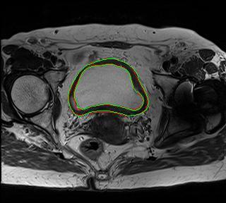 Segmentação Segmentação da bexiga a partir de imagens de ressonância magnética: modelos de level set, conhecimento prévio Segmentação das paredes internas e