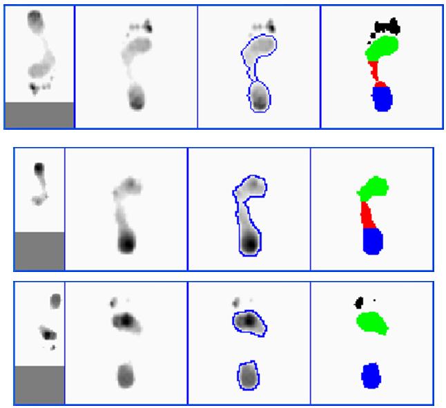 Alinhamento Alinhamento de imagens de pedobarografia para identificação (esq. / direito), extração de medidas e índices Oliveira et al.