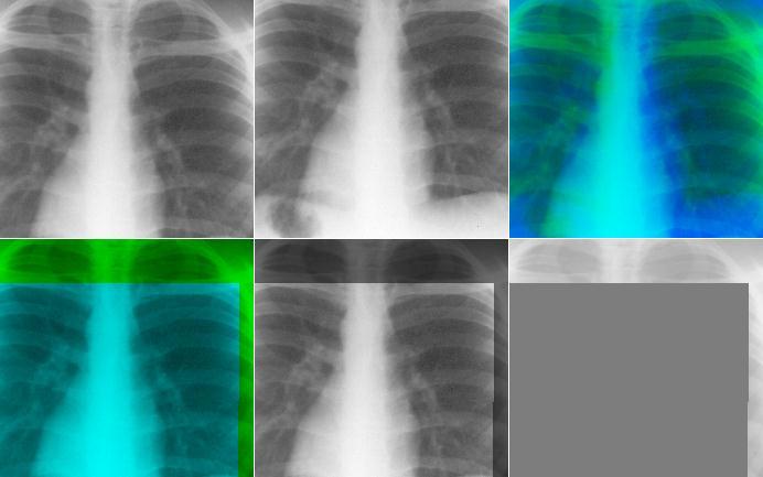 Alinhamento Alinhamento de imagens de uma mesma modalidade: otimização pelo Método de Powell de medida de semelhança (MSE) Soma Imagem originais (RX) ROI para cálculo da MSE Imagens