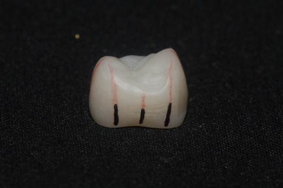 48 Figura 7- Marcações realizadas nas faces vestibular, palatina, mesial e distal. 4.6.