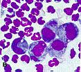 Células Encontradas célula mesotelial macrófagos neutrófilos outras: eosinófilos, linfócitos, mastócitos, eritrócitos, células neoplásicas Tipos de Efusão transudato simples transudato modificado