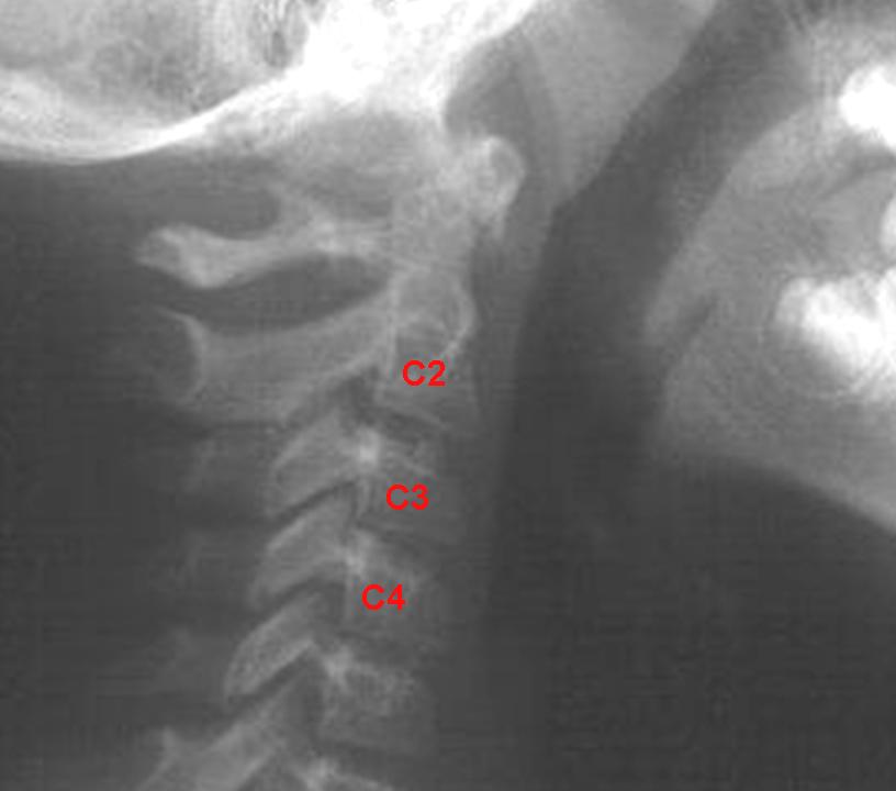 53 FIGURA 4 Imagem radiográfica das vértebras