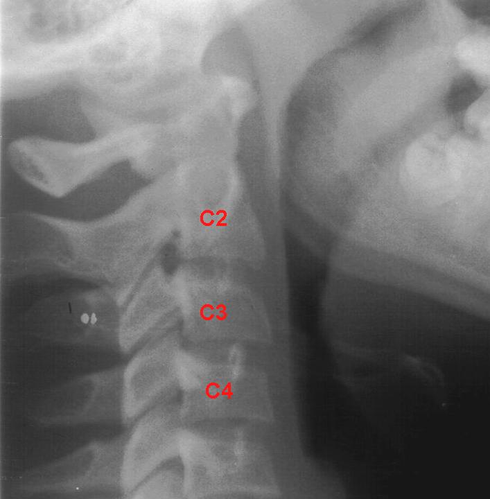 54 FIGURA 6 Imagem radiográfica das vértebras