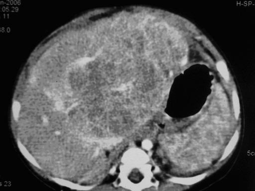 Serão referidos outros tumores malignos menos frequentes, que é importante referir, pela forma de apresentação clínica, localização e prognóstico: Hepatocarcinoma, Rabdomiosarcoma e Linfomas.