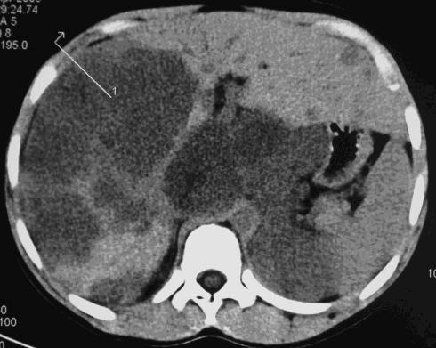 Apresenta alterações cromossomáticas (11p13,WT1) e podem estar associados a outras patologias: hemihipertrofia, Síndrome de WAGR, Drash, Bekwith- Wiedmann entre outros.