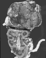 O Doppler colorido dirigido ao hilo renal é importante para planear a abordagem cirúrgica: heminefrectomia/ tumorectomia ou nefrectomia.