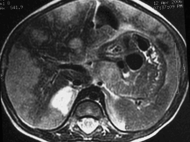 Estadiamento/Prognóstico: NWTS (National Wilm s Tumor Study, SIOP): I: Intra renal e totalmente extirpado II: Invasão local e completamente extirpado III: Excisão incompleta, sem metástases IV: